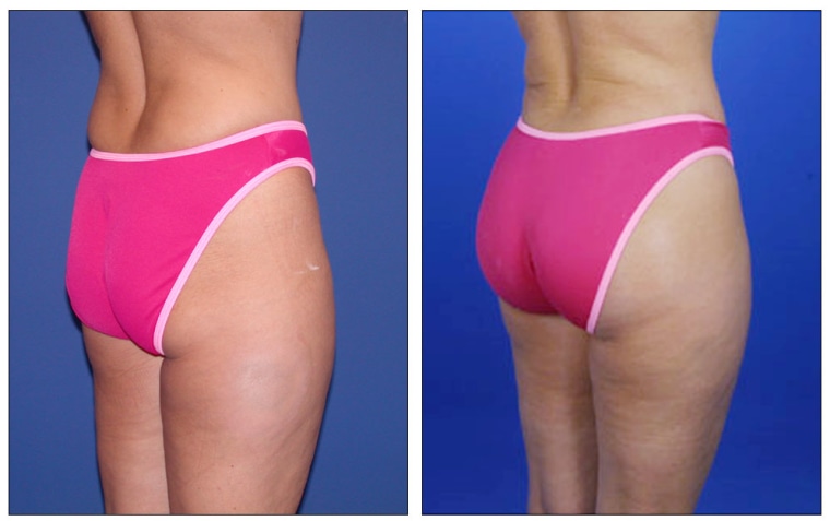 Images of Lynne, a patient in St. Louis, taken before and after her buttock-implant surgery.